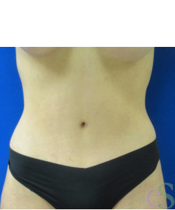 After Image: Tummy Tuck Patient 61 - front