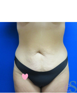 Before Image: Tummy Tuck Patient 61 - front