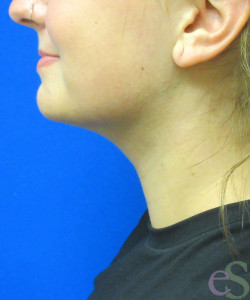After Image: Liposuction of Neck/Chin Patient 6 - left-side