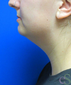 Before Image: Liposuction of Neck/Chin Patient 6 - left-side