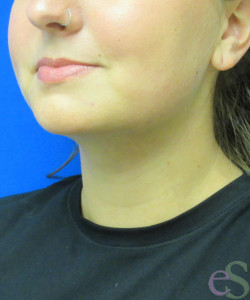 After Image: Liposuction of Neck/Chin Patient 6 - left-front-oblique