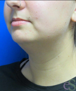 Before Image: Liposuction of Neck/Chin Patient 6 - left-front-oblique