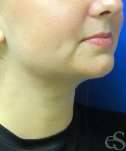 After Image: Liposuction of Neck/Chin Patient 6 - right-front-oblique
