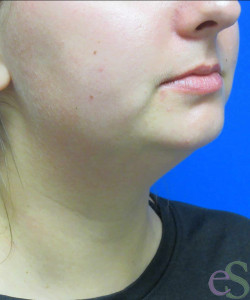 Before Image: Liposuction of Neck/Chin Patient 6 - right-front-oblique