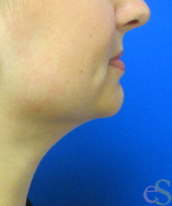 After Image: Liposuction of Neck/Chin Patient 6 - right-side