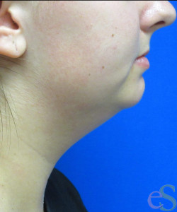 Before Image: Liposuction of Neck/Chin Patient 6 - right-side