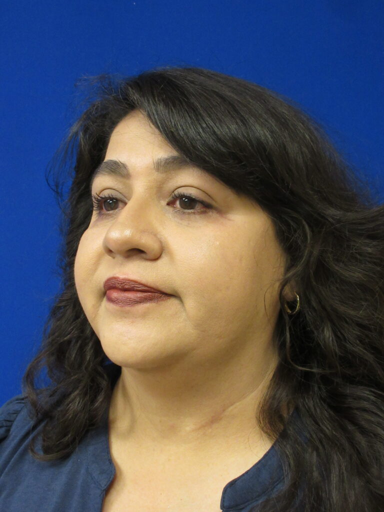 After Image: Blepharoplasty Patient 12 - left-front-oblique