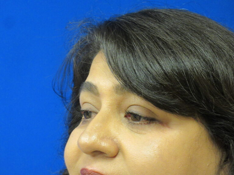 After Image: Blepharoplasty Patient 12 - left-front-oblique
