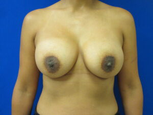 After Image: Breast Augmentation Patient 163