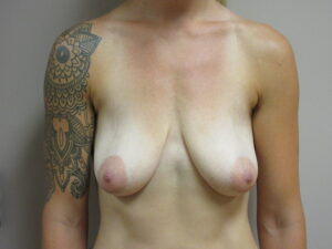 Before Image: Breast Augmentation with Lift Patient 26