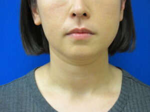 Before Image: Liposuction of chin and neck Patient 7