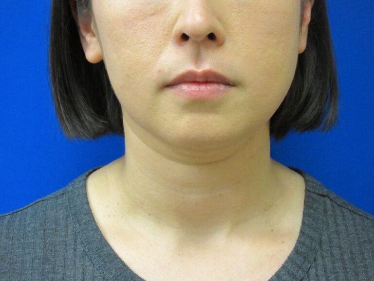 Before Image: Liposuction of chin and neck Patient 7 - front