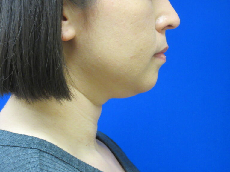 Before Image: Liposuction of chin and neck Patient 7 - right-side