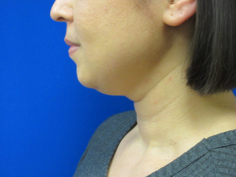 Before Image: Liposuction of chin and neck Patient 7 - left-side