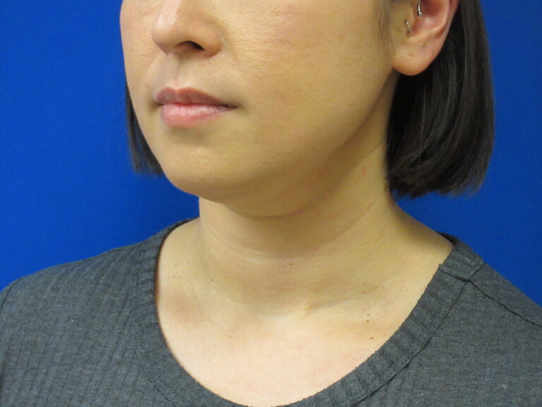 Before Image: Liposuction of chin and neck Patient 7 - left-front-oblique