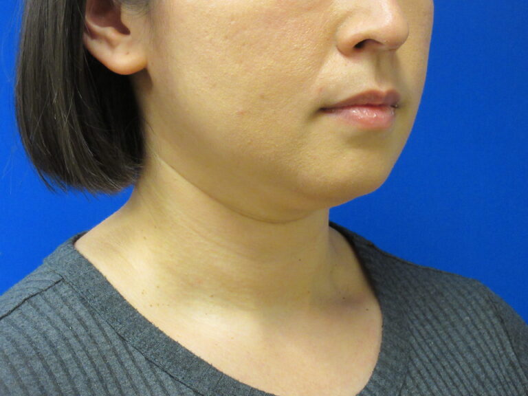 Before Image: Liposuction of chin and neck Patient 7 - right-side