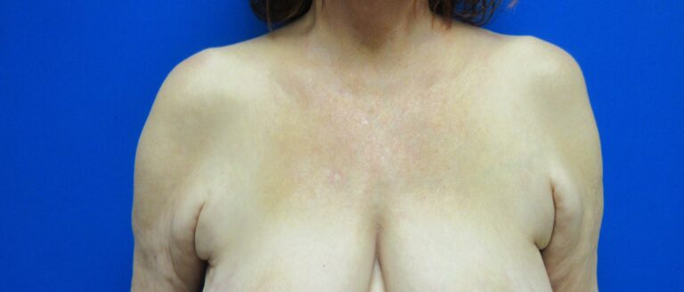 Before Image: Arm Lift / Brachioplasty Patient 11 - front