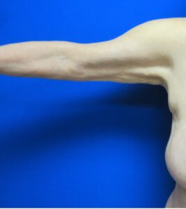 Before Image: Arm Lift / Brachioplasty Patient 11