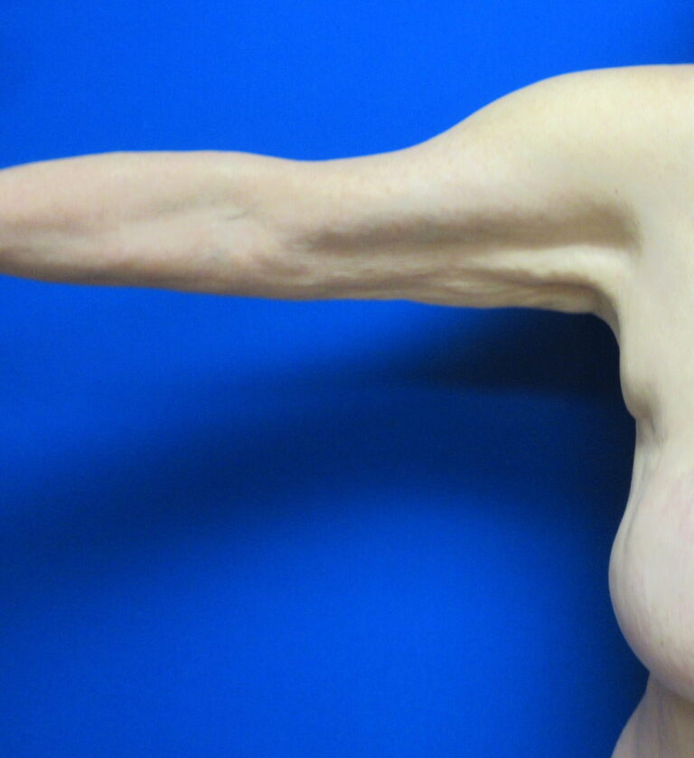 Before Image: Arm Lift / Brachioplasty Patient 11 - back
