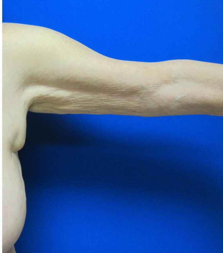 Before Image: Arm Lift / Brachioplasty Patient 11 - front