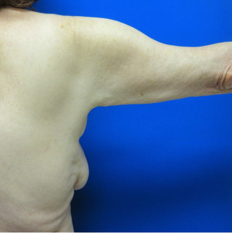 Before Image: Arm Lift / Brachioplasty Patient 11 - back