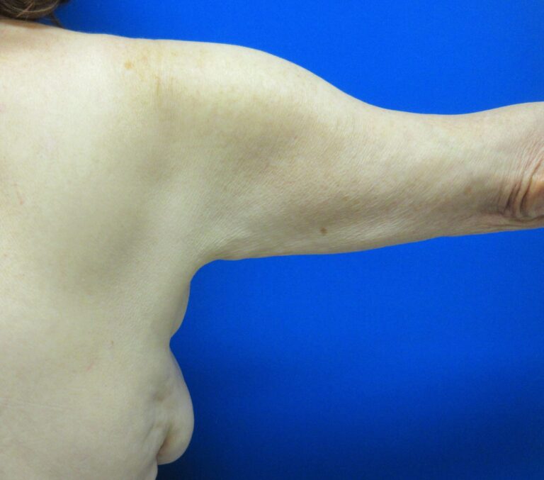 Before Image: Arm Lift / Brachioplasty Patient 11 - back