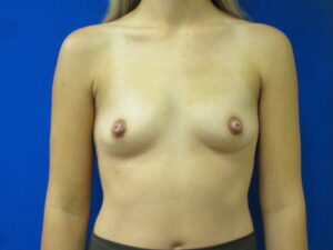 Before Image: Breast Augmentation Patient 164