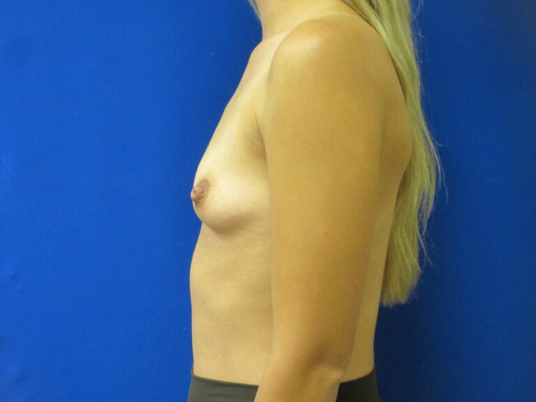 Before Image: Breast Augmentation Patient 164 - left-side