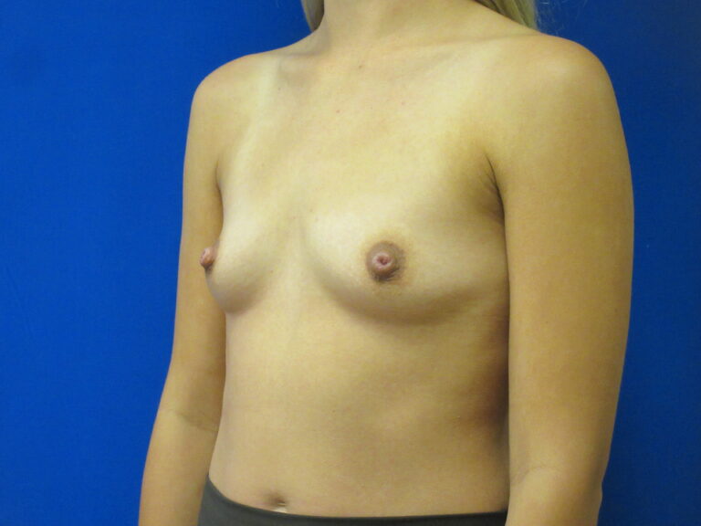 Before Image: Breast Augmentation Patient 164 - left-front-oblique