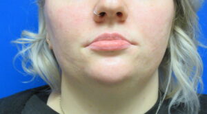 Before Image: Lip Enhancement Patient 3