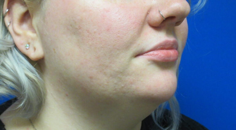 Before Image: Lip Enhancement Patient 3 - right-front-oblique