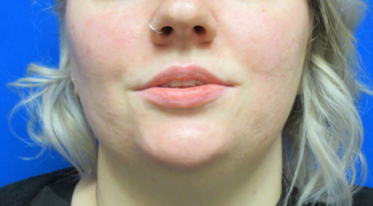 Before Image: Lip Enhancement Patient 3 - front