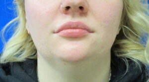 After Image: Lip Enhancement Patient 3