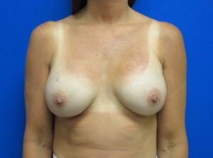 Before Image: Breast Implant Remove and Replace Patient 12
