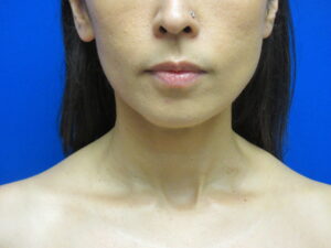 After Image: Liposuction of chin and neck Patient 7