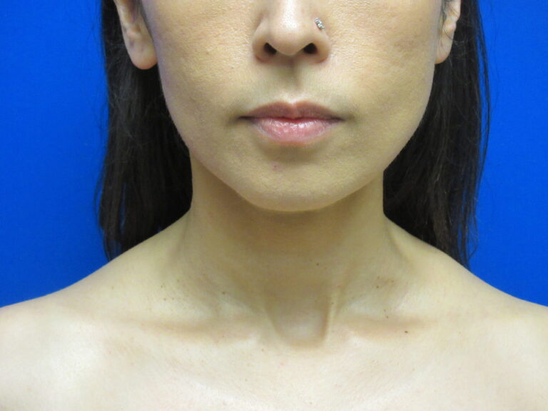 After Image: Liposuction of chin and neck Patient 7 - front