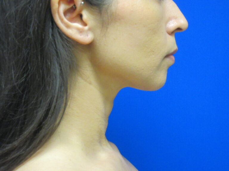 After Image: Liposuction of chin and neck Patient 7 - right-side