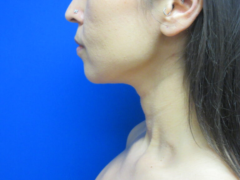 After Image: Liposuction of chin and neck Patient 7 - left-side