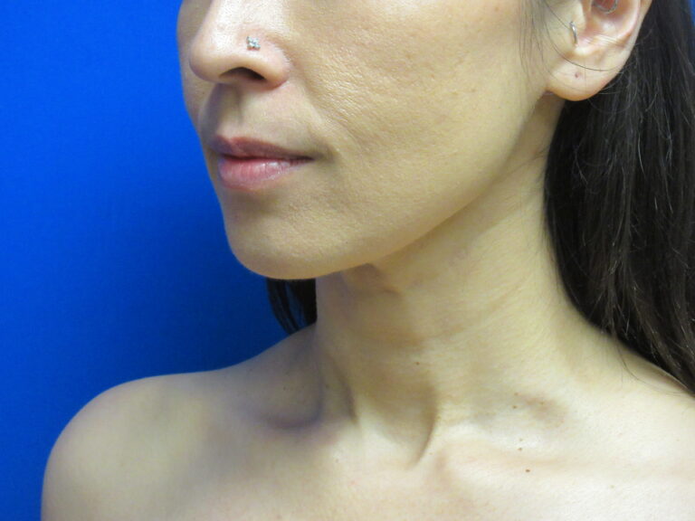 After Image: Liposuction of chin and neck Patient 7 - left-front-oblique