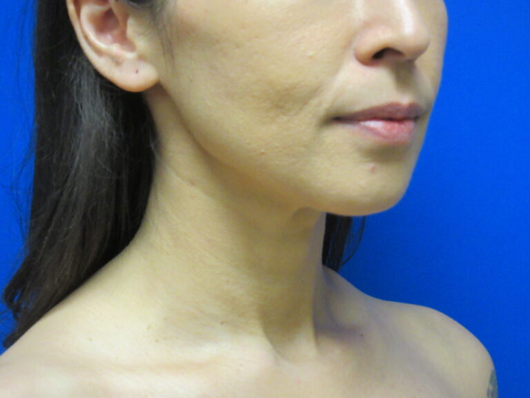 After Image: Liposuction of chin and neck Patient 7 - right-side