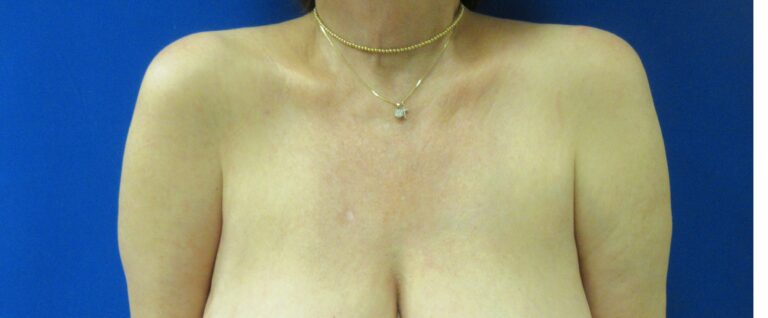 After Image: Arm Lift / Brachioplasty Patient 11 - front