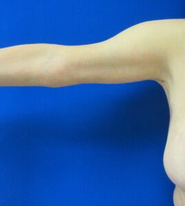 After Image: Arm Lift / Brachioplasty Patient 11