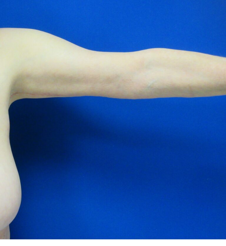 After Image: Arm Lift / Brachioplasty Patient 11 - front