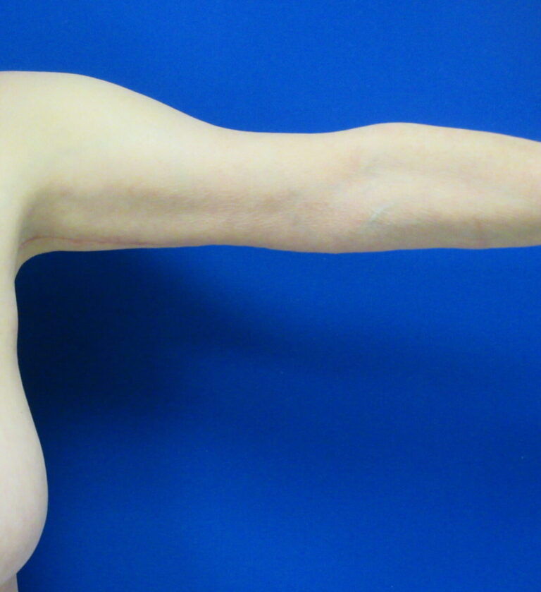 After Image: Arm Lift / Brachioplasty Patient 11 - front