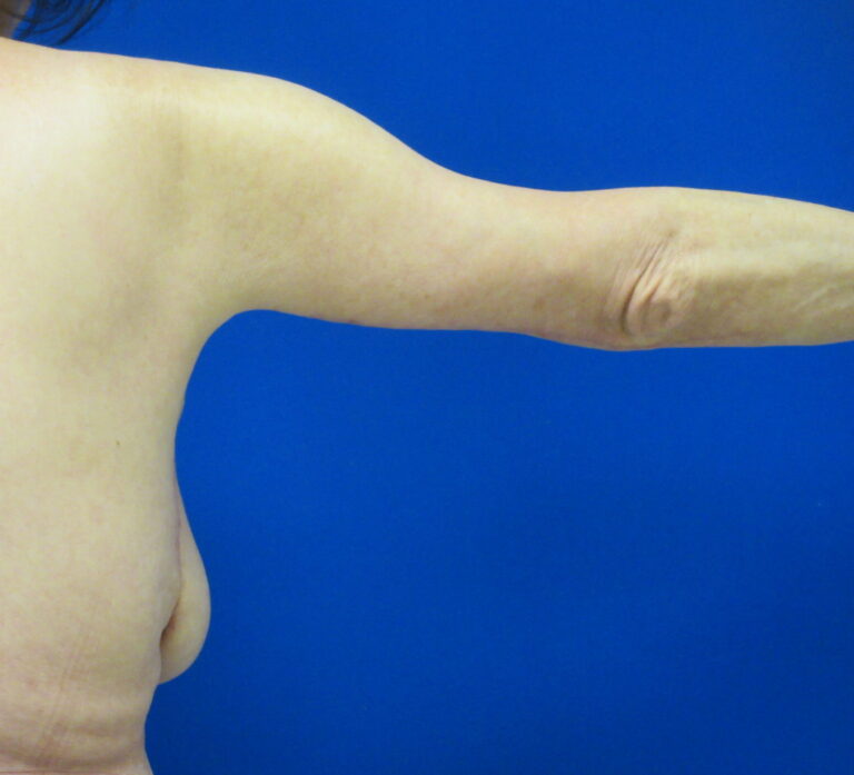 After Image: Arm Lift / Brachioplasty Patient 11 - back