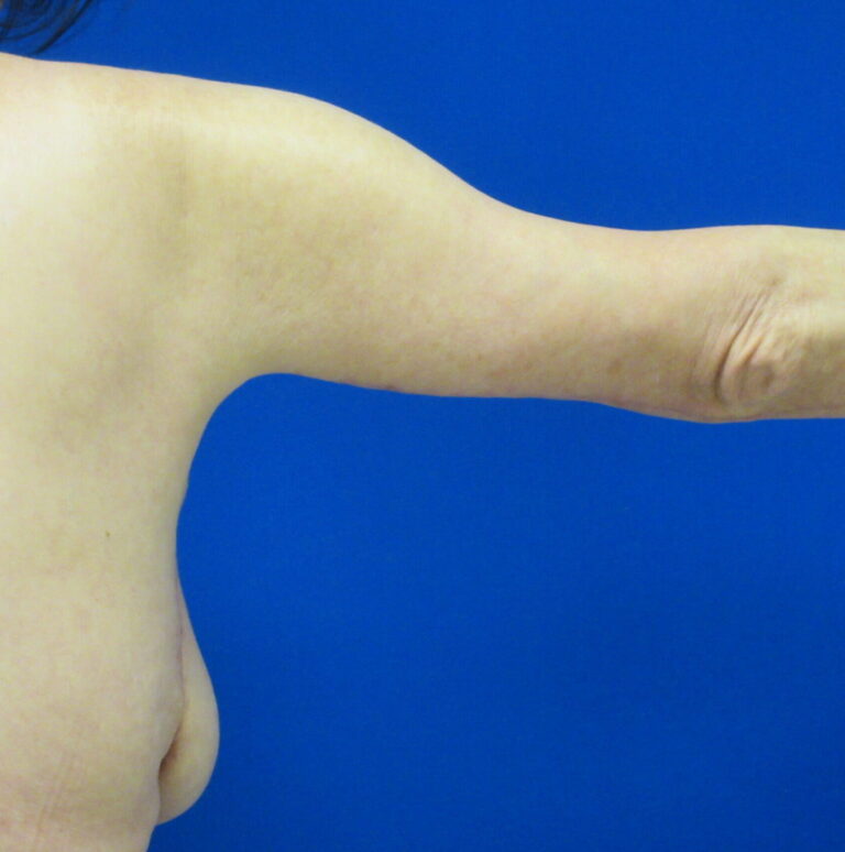 After Image: Arm Lift / Brachioplasty Patient 11 - back