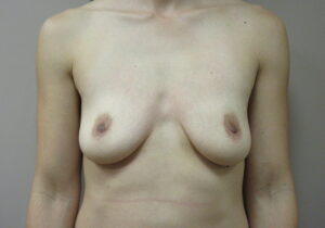 Before Image: Breast Augmentation Patient 165