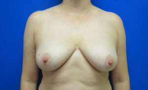 After Image: Breast Implant Removal Patient 3