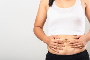 Woman holding her tummy with loose skin from pregnancy wanting a mommy makeover in San Antonio