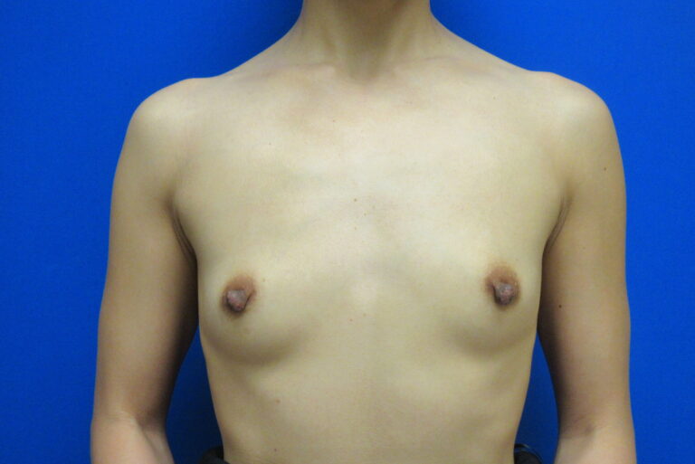 Before Image: Breast Augmentation Patient 166 - front